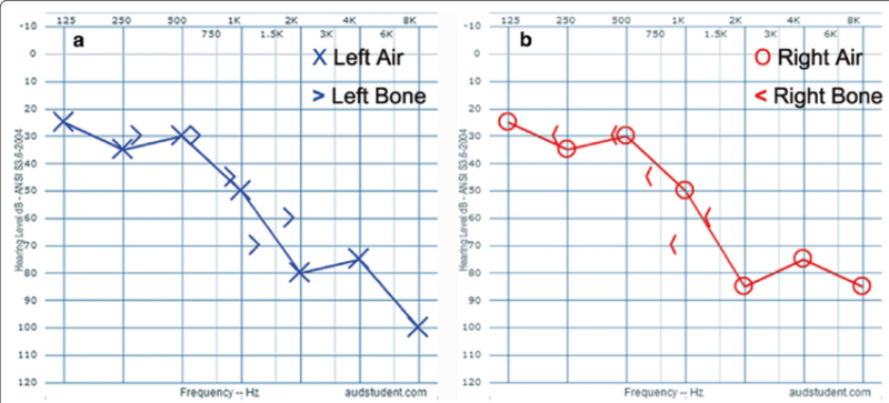 What Is The Audiogram Test? How Does It Work? - Hearing Aids